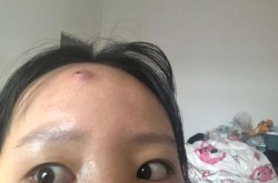 女子挤痘痘致脸部感染，挤痘痘发炎感染整个脸都肿了