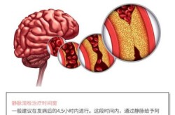 溶栓是治疗需要多少钱，静脉溶栓治疗一般多少钱