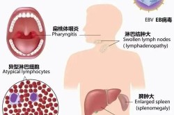 核病毒感染是什么症状，核病毒感染是怎么回事