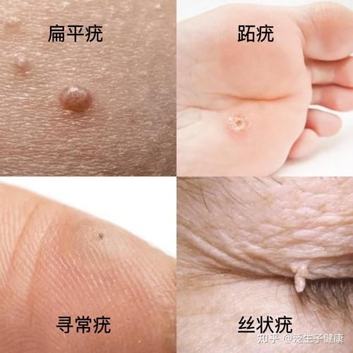 无症状感染者是什么情况?(感染hpv有什么症状)