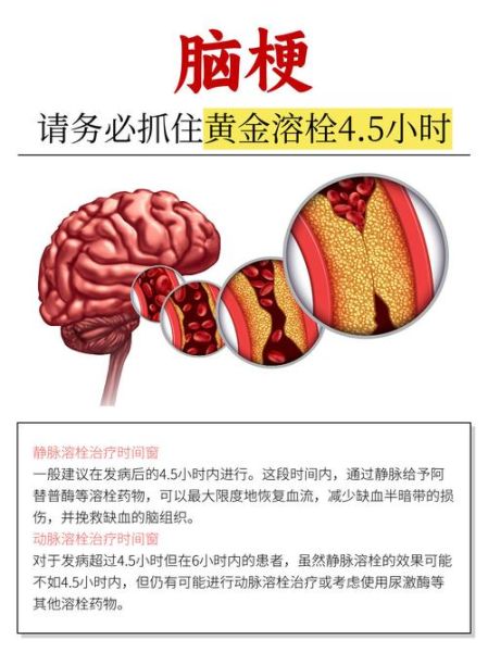 溶栓是治疗需要多少钱，静脉溶栓治疗一般多少钱