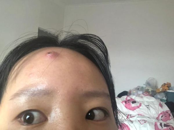 女子挤痘痘致脸部感染，挤痘痘发炎感染整个脸都肿了