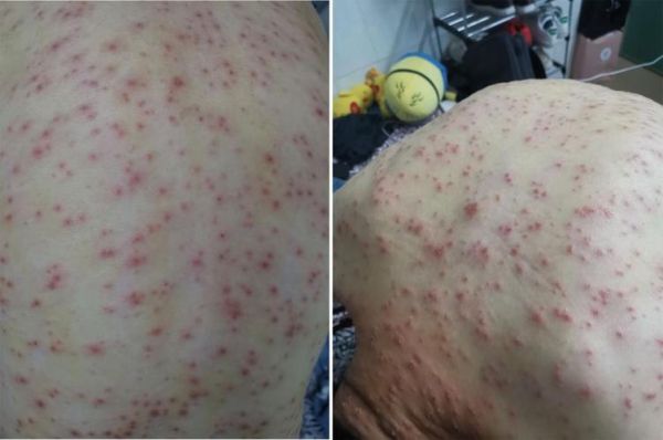身上病毒感染有什么症状，病毒感染全身5种症状