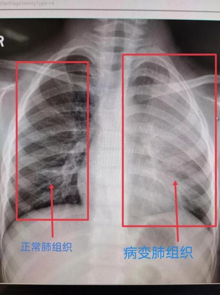 白肺都有哪些症状表现，白肺有哪些症状出现