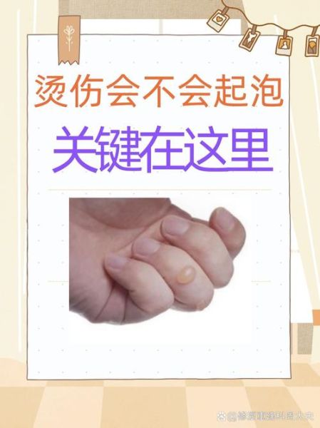 感染高峰期预测方法，烫伤第几天是感染高峰期