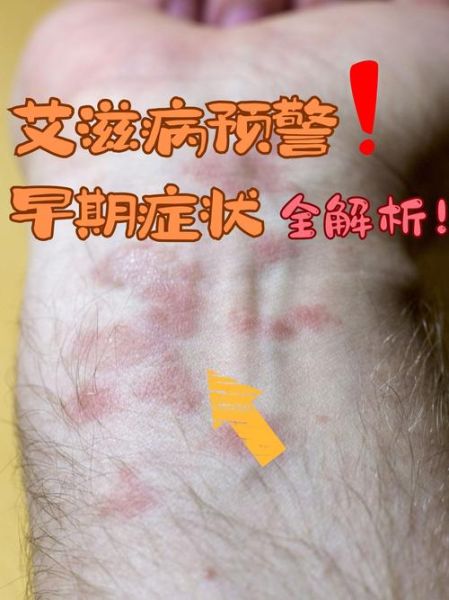 重庆首次出现四代感染病例是哪一年,重庆有多少人感染艾滋病毒